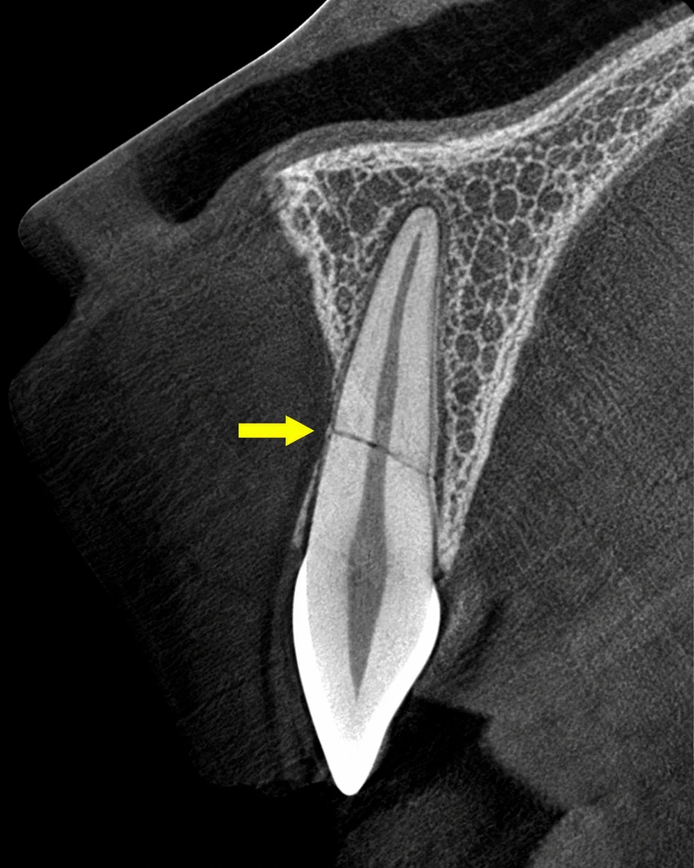 Illustrative sagittal CBCT view of an upper incisor with a yellow arrow indicating a root fracture, view 1