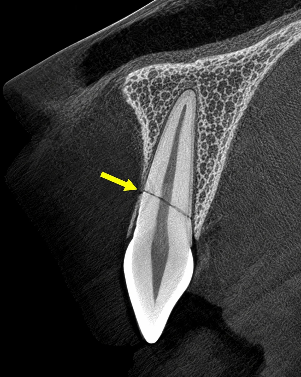 Illustrative sagittal CBCT view of an upper incisor with a yellow arrow indicating a root fracture, view 2