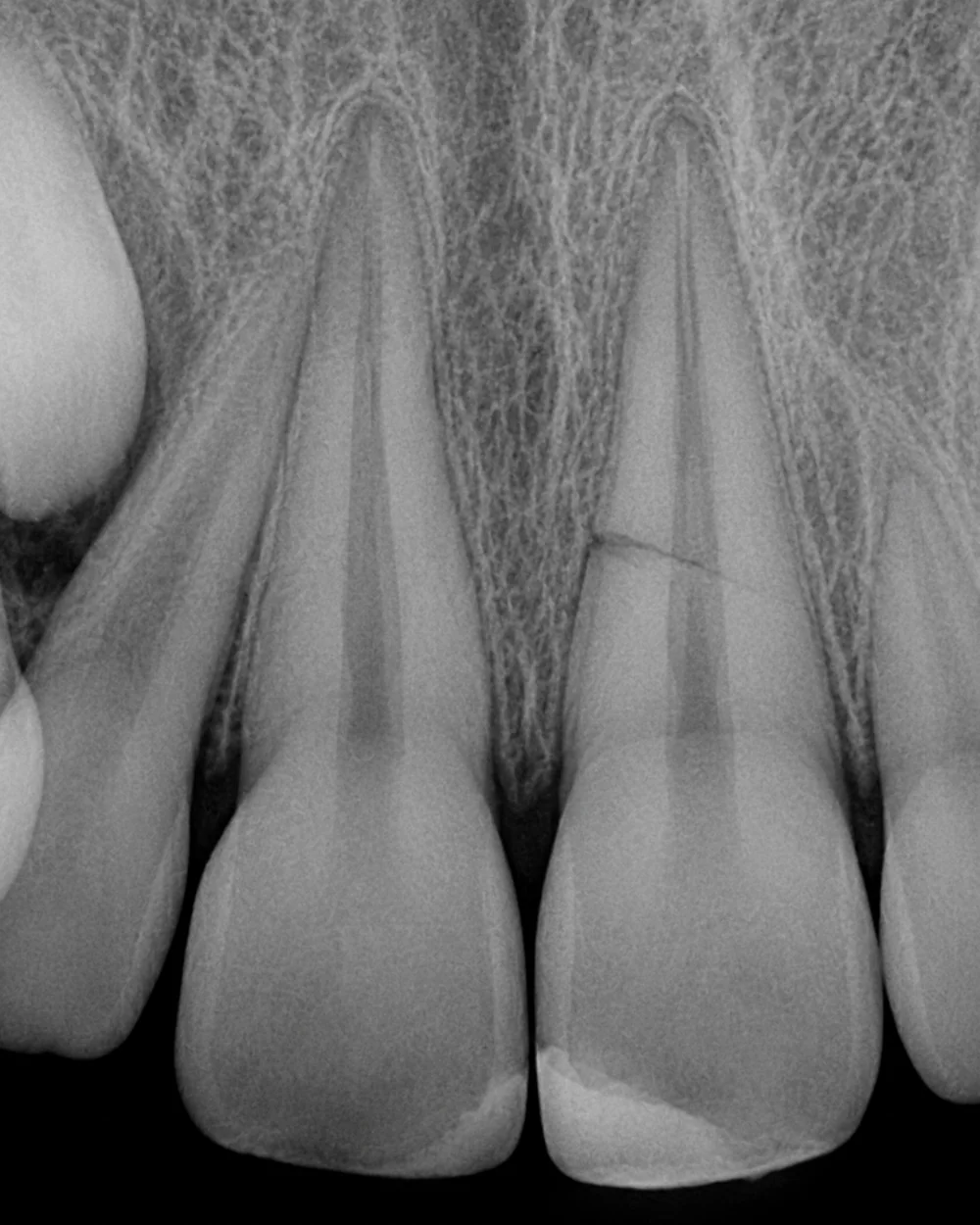 Illustrative periapical view of upper incisors depicting a transverse root fracture, based on a clinical reference